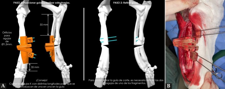 (A) Reproducción en 3D de la aplicación de la guía quirúrgica que permitirá realizar los cortes adecuados sobre el cúbito y radio (ostectomía) posibilitando así la mejor alineación de estos huesos. (B). Imagen de la colocación de la guía quirúrgica durante la intervención.