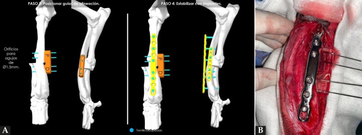(A)&nbsp;Reproducción en 3D de la aplicación de la guía de alineación para mantener la fijación de los huesos mientras se coloca la placa principal.&nbsp;(B) Aspecto de la placa puente recién colocada junto a la guía de alineación.