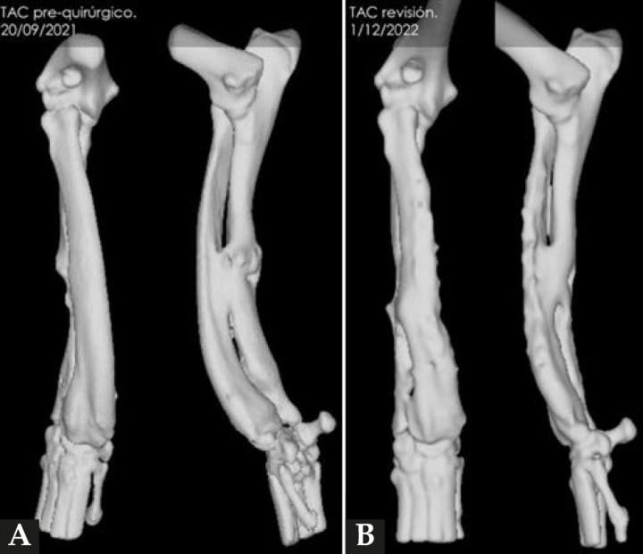 (A) Reconstrucción en 3D de los huesos del antebrazo afectado antes de realizar la ostectomía y colocar los implantes y (B) después de retirarlos.