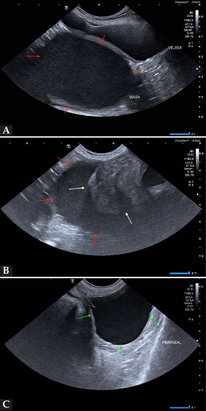 <p>Ecografía abdominal en plano sagital. (<strong>A</strong>, <strong>B</strong>) Masa rellena de fluido ecogénico, dorsal a la vejiga de la orina y que se extiende hacia el canal pélvico y región perineal (flechas rojas). (<strong>B</strong>) La masa presenta paredes gruesas y heterogéneas (flechas blancas). (<strong>C</strong>) Masa rellena de fluido en la región perineal (flechas verdes).</p>