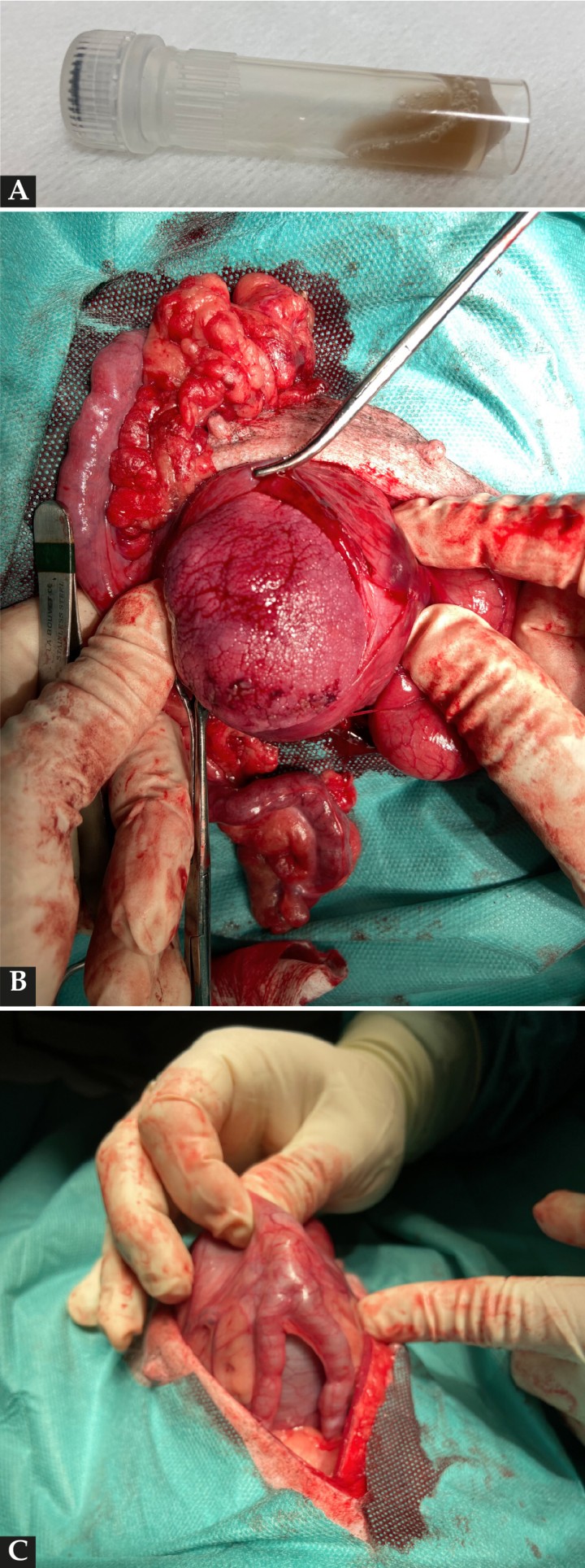 <p>Imágenes intraquirúrgicas. (<strong>A</strong>) Contenido del interior de la vagina. (<strong>B</strong>) Se observa la vagina con el fibroleiomioma vaginal. (<strong>C</strong>) El cuello del útero y ambos cuernos uterinos se muestran distendidos con fluido.</p>