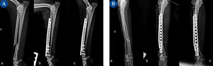 (A) Proyección mediolateral, (B) Proyección craneocaudal. Fractura diafisaria compleja de radio en un pomerania de 2,3 kg.(a) Fractura diafisaria compleja de radio. Además de presentar una fractura oblicua corta con un pequeño fragmento óseo (no reducible), la porción de radio proximal al foco primario presenta una fractura segmentaria espiroidea no desplazada.&nbsp;(b) Se realizó reducción abierta y fijación interna mediante un implante principal en la cara craneal, del radio, consistente en una placa bloqueada multiorificio poliaxial de titanio con cuatro tornillos bloqueados de 1,5 mm por&nbsp;fragmento, y como complemento una placa bloqueada de titanio, multiorificio, en la cara lateral, con dos tornillos bloqueados de 1,2 mm&nbsp;por fragmento. La distribución de los tornillos se realizó en los bordes más proximal y distal de ambas placas, dejando el centro libre. En un sistema de placas ortogonales, la posición de los tornillos no afecta a la resistencia al doblado o compresión, y levemente a la torsión.<sup>6</sup>(c) Evolución de la consolidación ósea a las 7 semanas postoperatorias.