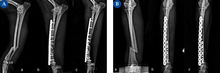 (A) Proyección mediolateral, (B) Proyección craneocaudal. Fractura diafisaria distal de cúbito y radio, oblicua corta en un lebrel italiano de 2,8 kg.(a) Fractura diafisaria distal de cúbito y radio, oblicua corta, con leve pérdida de stock óseo (fractura abierta, grado I).&nbsp;(b) En este caso, se opta por una estabilización con una placa principal en la cara craneolateral del radio mediante un implante bloqueado de titanio multiorificio poliaxial con tres tornillos bloqueados de 1,5 mm en el fragmento distal y cuatro en el fragmento proximal. Debido a la detección intraoperatoria de un defecto transcortical, se coloca una placa auxiliar en la cara medial del radio: placa bloqueada de titanio con dos tornillos de 1,2 mm bloqueados por fragmento. Gracias a esta configuración, podemos colocar cinco tornillos en el fragmento distal; utilizando una sola placa principal, solamente podríamos haber colocado tres.&nbsp;(c) Evolución de la consolidación ósea a las 6 semanas postoperatorias.