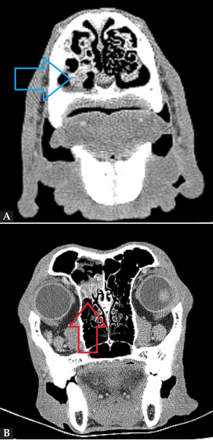 (A) Imagen de la TC de cráneo (región nasal, corte transversal en ventana de hueso postcontraste). Se observa una diferencia evidente entre la cavidad nasal derecha e izquierda, con moderada pérdida y destrucción de los turbinetes junto al engrosamiento de la mucosa y la presencia de tejido blando anómalo de la cavidad nasal izquierda (flecha azul). (B) Imagen de la TC de cráneo (región frontoorbitaria, corte transversal en ventana de hueso postcontraste). Se evidencia la presencia de engrosamiento de la mucosa y de tejido blando anómalo ubicado en el seno frontal izquierdo (flecha roja).
