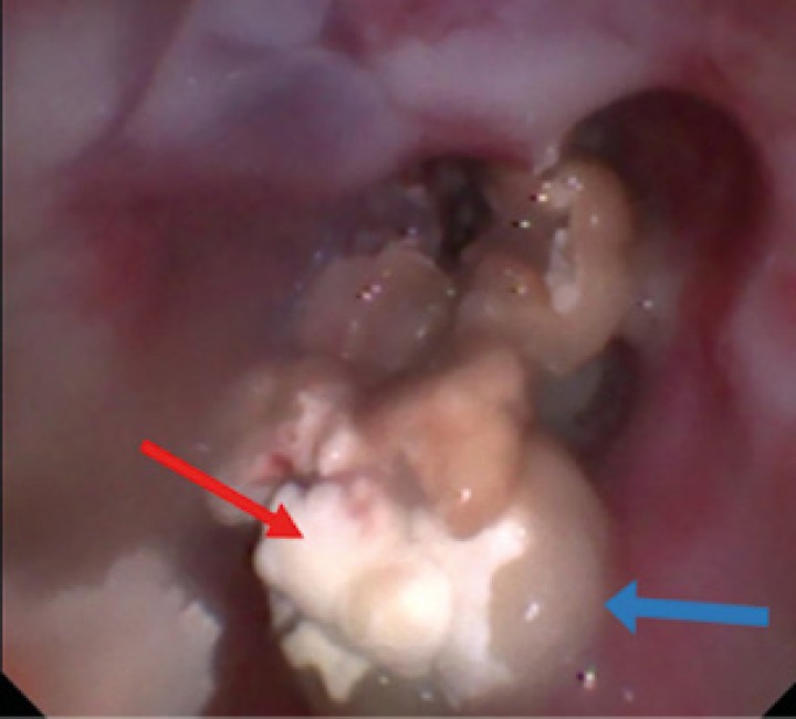 Imagen de la rinoscopia en cavidad nasal izquierda (meato nasal). Se pueden observar placas fúngicas de color blanquecino (flecha roja) y secreción mucopurulenta (flecha azul). Debido a la destrucción de los turbinetes presenta un aspecto más cavitado.