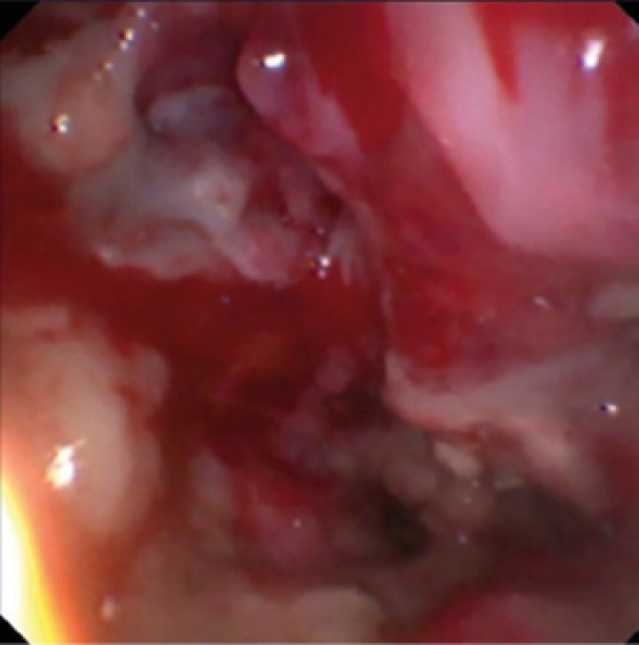 Aspecto tras el desbridamiento de la cavidad nasal izquierda (meato nasal), con ausencia del laberinto etmoidal. La mucosa presenta un aspecto eritematoso con focos de sangrado tras el proceso.