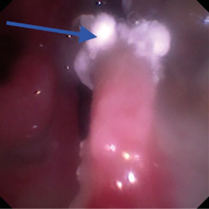 Rinoscopia de control tras 3 semanas del primer tratamiento con crema antifúngica. Se observan pequeñas placas (flecha azul).