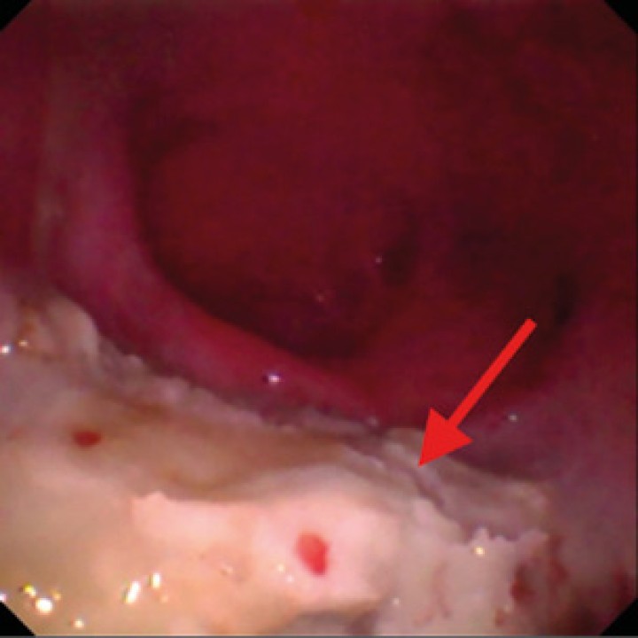 Visualización de las placas fúngicas (flecha roja) dentro del seno frontal izquierdo a través de los orificios realizados mediante trepanación.
