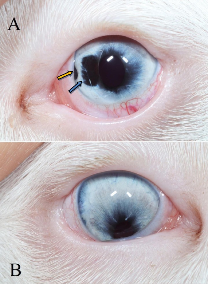<p>(<strong>A</strong>) Ojo izquierdo microftálmico con hipoplasia de iris a las 9:00 h (véase flecha azul) y un coloboma a las 9:00 h (véase flecha naranja). (<strong>B</strong>) Ojo derecho microftálmico con corectopia.</p>