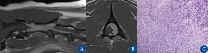 Meningioma espinal atípico canino (WHO grado II).&nbsp;Resonancia magnética: plano parasagital (A) y transversal T1 (B) post contraste en un perro, macho castrado, de 9 años de edad con una historia crónica progresiva compatible con una mielopatía cervical craneal (mielopatía C1-C5). Se observa una masa intradural-extramedular de gran tamaño que realza de manera homogénea tras la administración de contraste paramagnético (gadolinio), lateralizada hacia la izquierda desde el nivel del cuerpo craneal C2 al espacio del disco intervertebral C2-C3. La lesión provoca un efecto de masa sobre la médula, que se desplaza hacia el lado derecho, y está en contacto directo con la cara dorsal de la médula y con su superficie lateral izquierda. La imagen histopatológica [(C), imagen cedida por la Dr. Jéssica Molín] corresponde a la biopsia quirúrgica que muestra una proliferación neoplásica no encapsulada, de elevada densidad, compuesta por células atípicas, leve a moderadamente pleomórficas, predominantemente poligonales, organizadas en nidos sólidos de tamaño variable separados por finas trabéculas de tejido fibrovascular compatible con un meningioma atípico grado II.