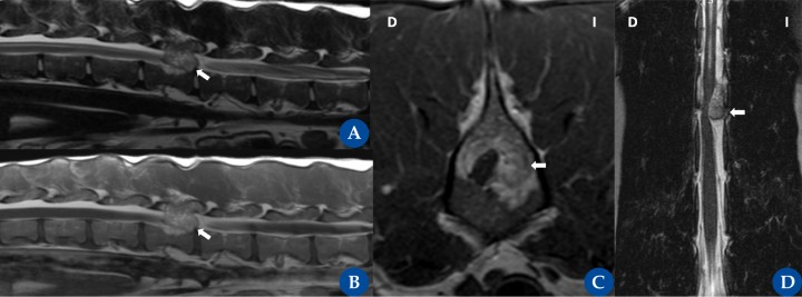 Tumor espinal extradural (osteosarcoma).&nbsp;Resonancia magnética: plano sagital ponderado en T2 (A), ponderado en T1 post contraste (B), transversal ponderado en T1 post contraste (C) y dorsal ponderado en T2 (D) en un galgo, hembra castrada de 6 años, con una historia crónica progresiva, de 3 meses de evolución, desde la cirugía de castración, de ataxia propioceptiva de las extremidades pélvicas y paraparesia ambulatoria marcada. Se observa una masa de gran tamaño, extradural, que ocupa espacio dentro de la cara izquierda del canal vertebral al nivel de L2, y que se extiende desde el aspecto medial de L2 hasta el nivel del espacio del disco intervertebral. La lesión ocupante de espacio está bien definida y tiene forma ovoide. La médula espinal está marcadamente desplazada hacia el lado contralateral y marcadamente comprimida con una forma irregular. El hueso circundante del cuerpo vertebral, los pedículos vertebrales y la lámina vertebral tienen alteración de la señal en T2 y T1. La superficie cortical está principalmente lítica y destruida. La intensidad de la señal en T2 y T1 se extiende a lo largo del proceso espinal elevando la musculatura epaxial. No se aprecia un realce de contraste. El canal central de la médula espinal está moderadamente dilatado cranealmente (D) a la lesión que ocupa el espacio. La citología con aguja fina (ecoguiada) fue compatible con un osteosarcoma.