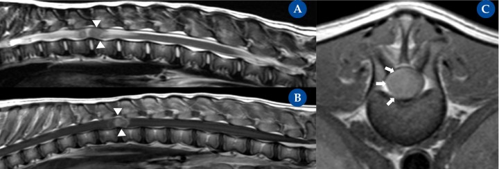 Tumor intramedular (nefroblastoma).&nbsp;Resonancia magnética: plano sagital ponderada en T2 (A), ponderada en T1 post contraste (B) y transversal ponderada en T1 post contraste (C) en un bulldog americano, de 5 meses de edad, hembra entera, con una historia crónica progresiva, de 6 semanas de evolución, de ataxia generalizada propioceptiva en ambos miembros pélvicos y paraparesia ambulatoria severa. La resonancia magnética mostró una masa intramedular (aunque inicialmente no se pudo descartar un componente intradural) a nivel de T12-T13 con realce focal y homogéneo tras la administración de contraste. La masa ocupa la casi totalidad del área de la médula espinal. En la secuencia de T2 se aprecian cambios intramedulares craneal y caudal a la masa intramedular compatible con edema medular. La posterior necropsia de la paciente confirmó la existencia de un nefroblastoma intramedular.