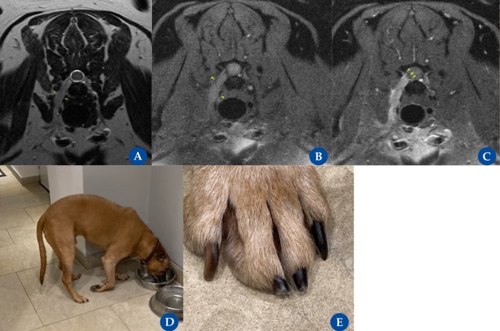 Tumor de vaina nerviosa periférica del nervio C8 derecho.&nbsp;Resonancia magnética: plano transversal ponderado en T2 (A), T1 con saturación de grasa (B) y T1 post contraste con saturación de grasa (C) en un perro mestizo, macho castrado, de 8 años de edad con una historia progresiva, de 3 meses de evolución, de cojera con evolución a monoparesia de la extremidad anterior derecha (EAD). Se observa un engrosamiento de la raíz nerviosa C8 derecha (flecha amarilla en A), con atenuación de la grasa foraminal. La raíz nerviosa se extiende ventralmente, formando nódulos y/o lesiones tubulares gruesas laterales a la tráquea y, luego, curvándose lateralmente hacia el plexo braquial (flechas amarillas en B). Tras la administración de medio de contraste, se produce un realce difuso de la raíz nerviosa. En C7-T1, la demarcación entre el saco dural y la raíz nerviosa realzada es irregular y está mal marginada, lo que también sugiere potencialmente una infiltración temprana de los márgenes del saco dural (flechas amarillas en C). En (D) se aprecia un “knuckling” espontáneo de la EAD, lo que sugiere déficits propioceptivos y en (E), un desgaste crónico de las uñas centrales debido al déficit propioceptivo crónico del paciente.