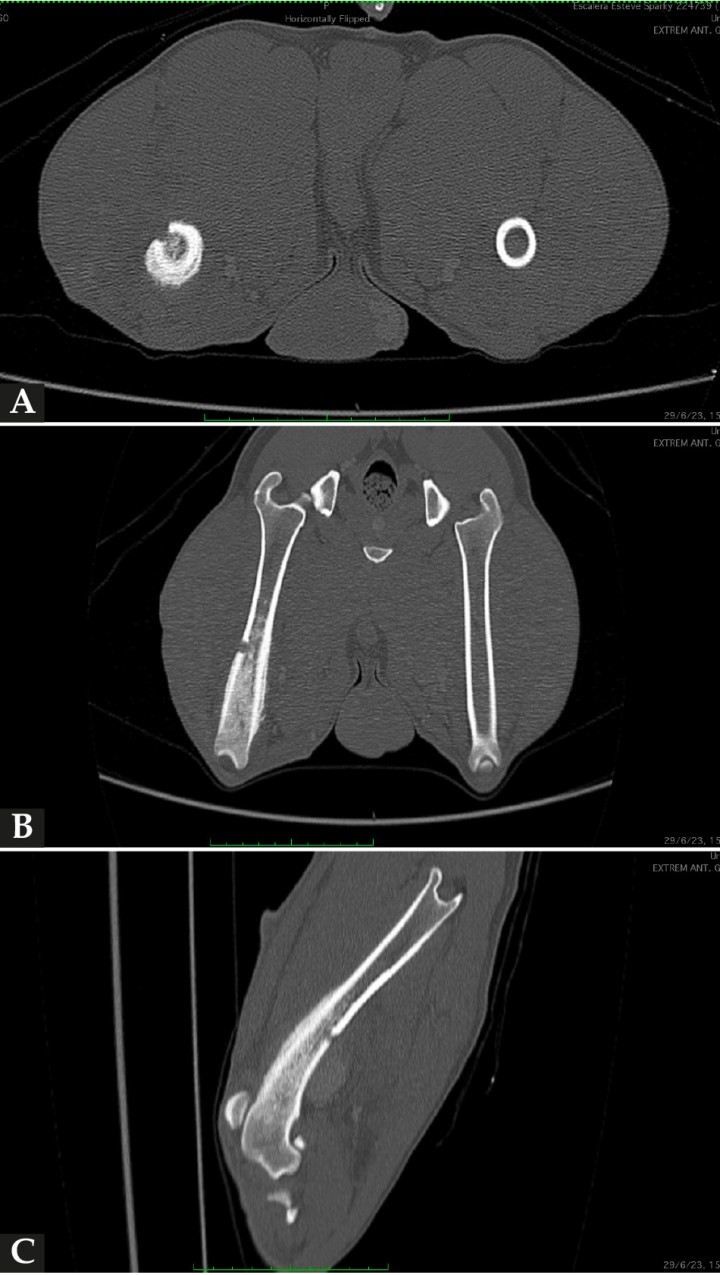 <div class=\"Marco-de-texto-b-sico\" id=\"_idContainer298\">
<p>(<strong>A</strong>) Imagen de TC en ventana hueso en un corte transversal. En la sección femoral de la extremidad pelviana derecha se observa una lesión agresiva con reacción perióstica y aumento de la atenuación medular. Se aprecia asimismo un defecto cortical presumiblemente causado por la biopsia ósea realizada previamente. (<strong>B</strong>) Imagen de TC en ventana hueso reconstruida en plano dorsal. En el fémur derecho se visualizan las lesiones óseas descritas en (<strong>A</strong>). (<strong>C</strong>) Imagen de TC en ventana hueso reconstruida en plano sagital. Se observa la lesión ósea de características agresivas y el defecto cortical descrito en (<strong>A</strong>). Caudodistalmente al defecto óseo provocado presumiblemente durante la biopsia, se intuye una estructura redondeada ligeramente hiperatenuante respecto a los tejidos adyacentes compatible con el pseudoaneurisma descrito en este caso.</p>
</div>