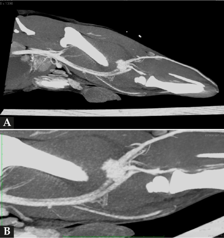 <p>(<strong>A</strong>) Imagen de TC en ventana tejidos blandos, tras la administración de contraste, reconstruida en plano sagital y MIP (proyección de máxima intensidad). Se observa una estructura redondeada con marcada captación de contraste caudal al fémur y caudodistal al defecto femoral. (<strong>B</strong>) Imagen de TC en ventana de tejidos blandos, tras la administración de contraste, reconstruida en plano sagital oblicuo y MIP. Detalle de la lesión descrita en (<strong>A</strong>) y de su relación con la vascularización regional.</p>