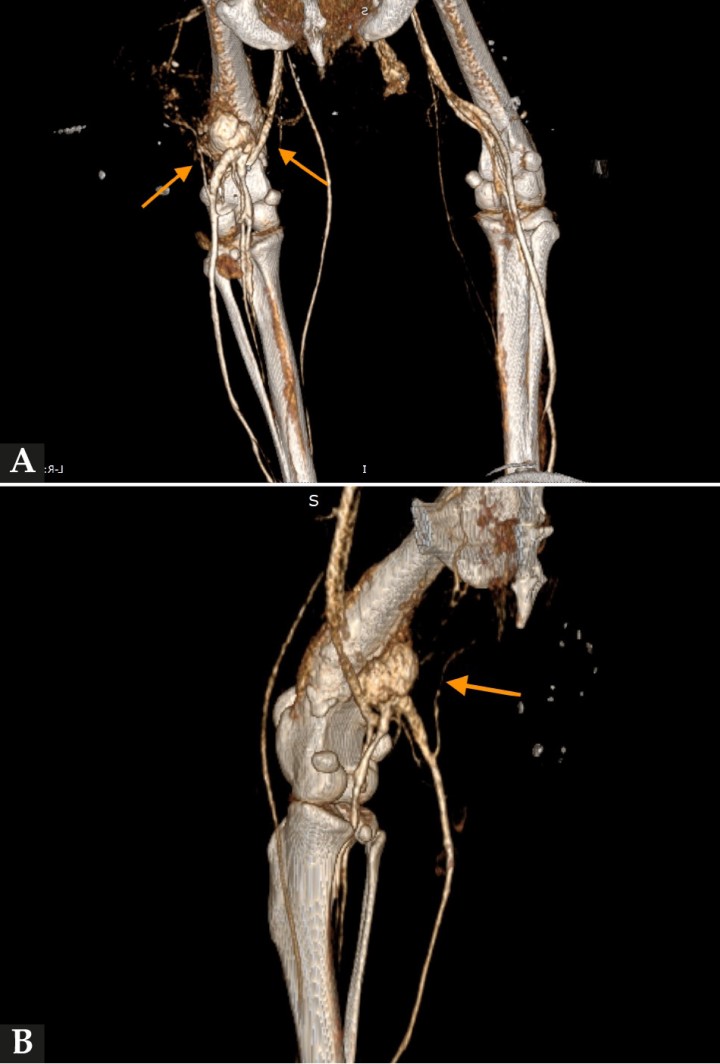 <p>(<strong>A</strong>) Imagen de TC reconstruida en Volumen Rendering (3D), tras administración de contraste (visión caudal). Se observa, caudalmente al aspecto distal de la diáfisis femoral, una estructura redondeada con gran captación de contraste (flechas naranjas) aparentemente conectada con la vena femoral y en íntima relación con la arteria femoral. (<strong>B</strong>) Imagen de TC reconstruida en Volumen Rendering (3D), tras administración de contraste (visión medial oblicua), donde se observa la estructura vascular descrita en (<strong>A</strong>) (flecha naranja).</p>