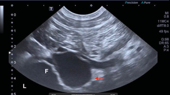 <p>Imagen ecográfica en plano transversal desde el aspecto caudal del fémur. La izquierda de la imagen corresponde a la zona lateral de la extremidad. A nivel lateral se visualiza una estructura hiperecoica de superficie irregular con sombra acústica compatible con la cortical femoral alterada ya descrita. En íntimo contacto con ella se observa una estructura redondeada, de contenido hipoecoico y con estrecha relación con la vascularización regional sugestiva de lesión aneurismática (flecha roja). “L”: lateral; “F”: fémur.</p>