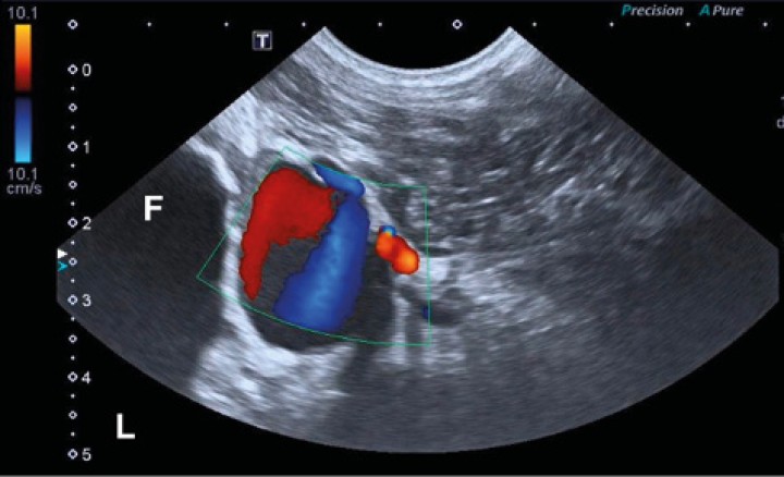 <p>Imagen ecográfica en plano transversal con empleo de Doppler color en la región caudodistal de la diáfisis del fémur derecho. Se observa una estructura redondeada que produce un efecto de remolino en el Doppler color (signo “ying-yang”). “L”: lateral; “F”: fémur.</p>