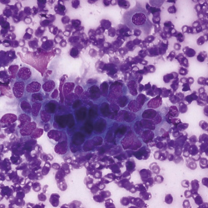 <p>Muestra citológica obtenida mediante punción con aguja fina ecoguiada de la lesión tonsilar. Se observan células epiteliales agrupadas sobre un fondo basófilo con moderada anisocitosis y anisocariosis, hallazgos compatibles con carcinoma. Imagen microscópica con tinción Diff-Quik a 400 X.</p>