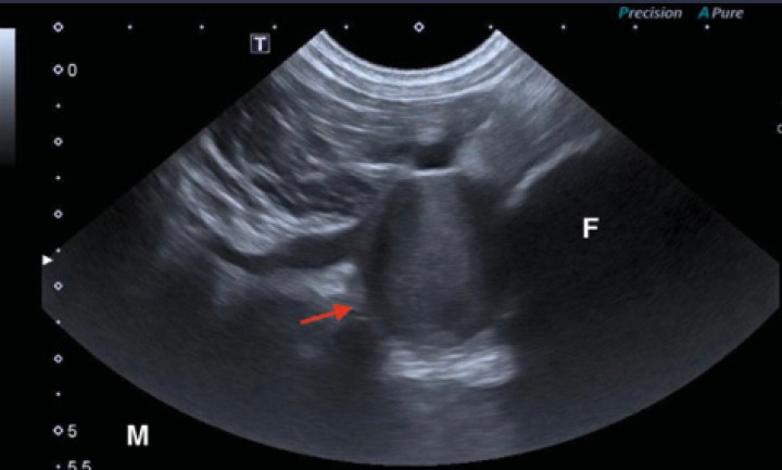 <p>Imagen ecográfica en plano transversal de la región caudodistal del fémur derecho. A la derecha de la imagen se observa una estructura de superficie hiperecoica con sombra acústica que representa la cortical femoral. Se observa una lesión redondeada con contenido ecogénico (flecha roja) que contrasta con el contenido hipoecoico de la vena femoral adyacente. Este hallazgo es compatible con trombosis de la estructura aneurismática visualizada en estudios anteriores. Estudio realizado 1 mes después de la primera ecografía. “M”: medial; “F”: fémur.</p>
