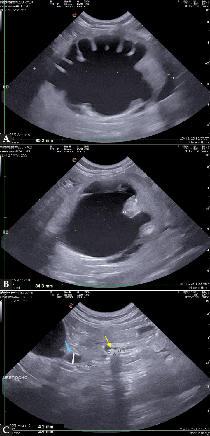(A) Imagen ecográfíca del riñón derecho en corte sagital en la que se observa dilatación de la pelvis renal con contenido ecogénico en suspensión y una marcada renomegalia asociada. (B) Imagen ecográfica de un corte transversal del riñón derecho en el que se observa una dilatación severa de la pelvis renal. (C) Imagen ecográfica del uréter derecho dilatado (flecha azul) y tortuoso justo craneal a un ureterolito obstructivo (flecha amarilla).