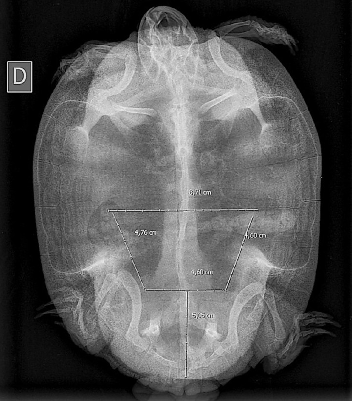 Simulación de la osteotomía sobre imagen radiológica.