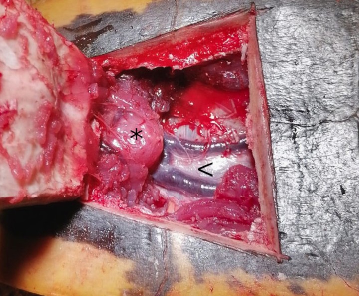 Venas abdominales ventrales (<) y borde craneal del pubis (*) al elevar el colgajo óseo.