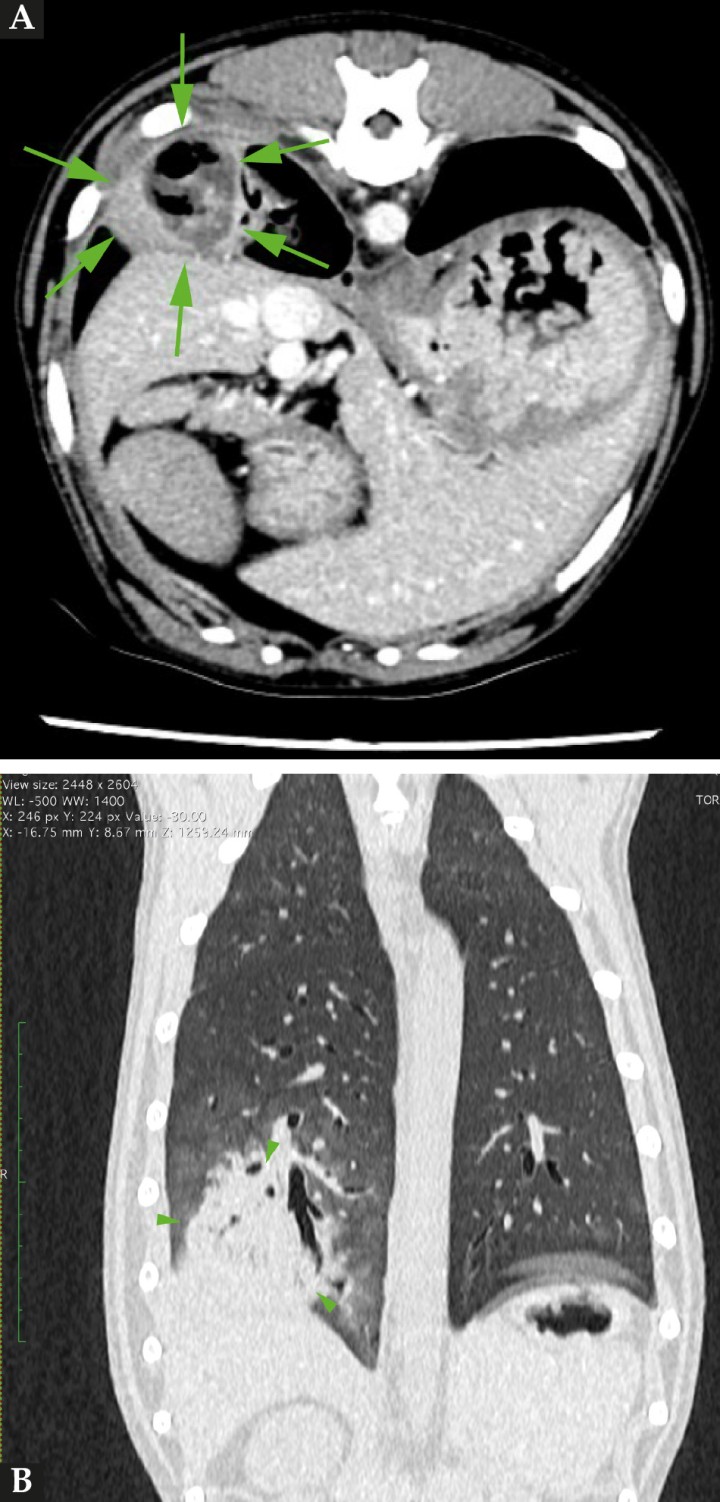 <p>(<strong>A</strong>) Imagen de TC en ventana tejido blando postcontraste de corte trasversal del tórax y ventana pulmón. (<strong>B</strong>) En corte dorsal a la altura de T10, se aprecia un incremento de atenuación del parénquima con la presencia de una masa de márgenes irregulares (4 cm de diámetro) (puntas de flecha) con cápsula bien definida y con captación de contraste (114 UH), y una cavidad con gas y necrosis/fluido en su interior.</p>