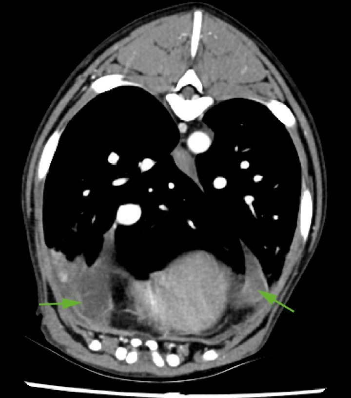 <p>Imagen de TC en ventana tejido blando postcontraste de corte trasversal; a la altura de T6, se evidencia presencia moderada de fluido pleural en ambos hemitórax (flechas).</p>