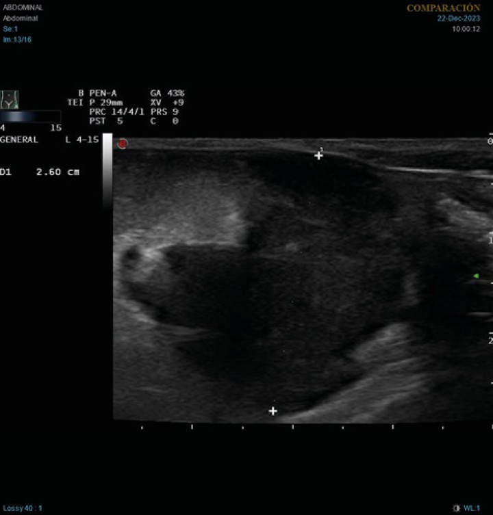 <p>Imagen ecográfica longitudinal del abdomen caudal. Masa heterogénea, principalmente hipoecoica, de 2,6 cm de diámetro, con hiperecogenicidad de la grasa adyacente.</p>