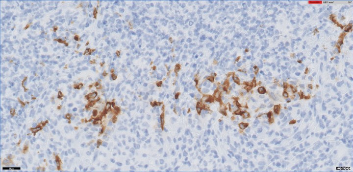 <p>Imagen histológica del linfonodo mesentérico 60 x. Tinción inmunohistoquímica. Numerosos macrófagos presentan inmunopositividad frente al anticuerpo con positividad cruzada con el coronavirus sistémico del hurón. Imagen cortesía de Laboratorios IDEXX.</p>
