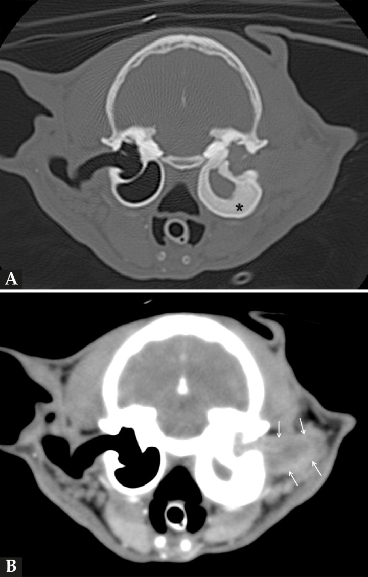 Imágenes de tomografía computarizada (TC) en plano transversal en ventana de huesos (A) y en ventana de tejidos blandos tras la administración de contraste (B) de la cabeza del paciente, en las que se visualiza severo engrosamiento y esclerosis de las paredes de la bulla timpánica izquierda (asterisco), cuyo interior se encuentra ocupado por material de atenuación tejido blando que se continúa hacia el conducto auditivo externo en el que se aprecia realce postcontraste de manera periférica (en anillo) (flechas).