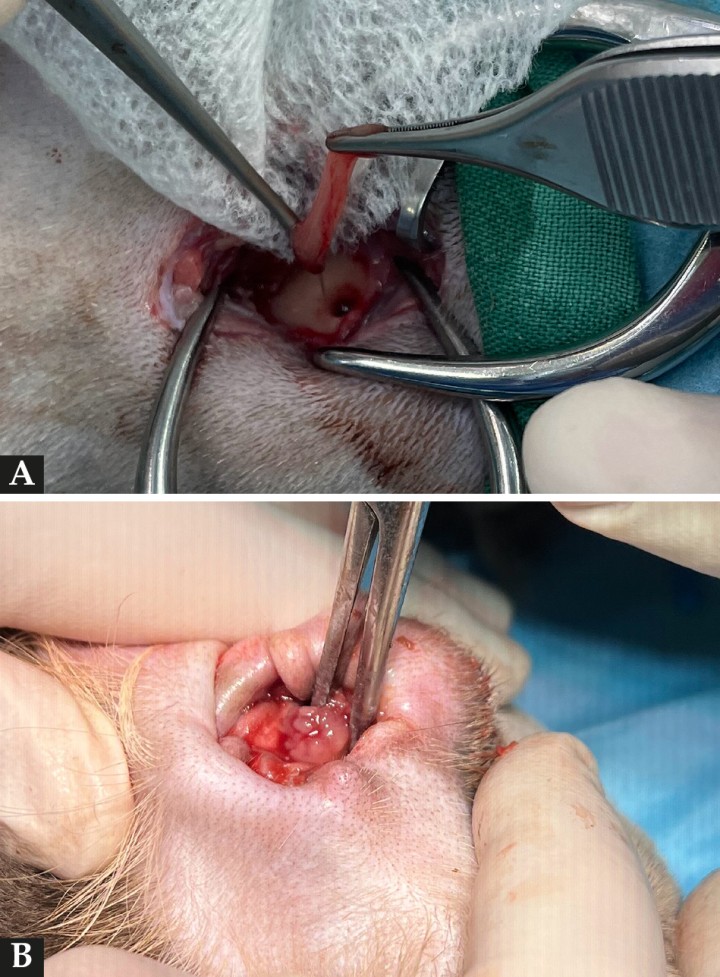 Imágenes intraoperatorias. (A) Vaciado del contenido de la bulla timpánica tras la realización de la doble osteotomía de la bulla timpánica izquierda. (B) Tracción del pólipo inflamatorio aural desde el conducto auricular vertical izquierdo.