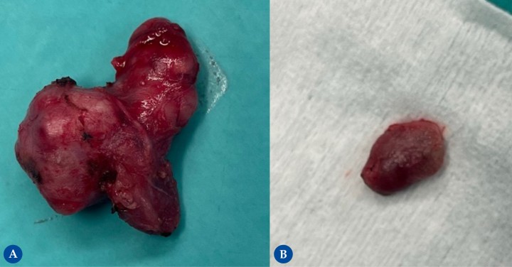 (A) Complejo mandibular-sublingual. (B) Linfonodo mandibular.
