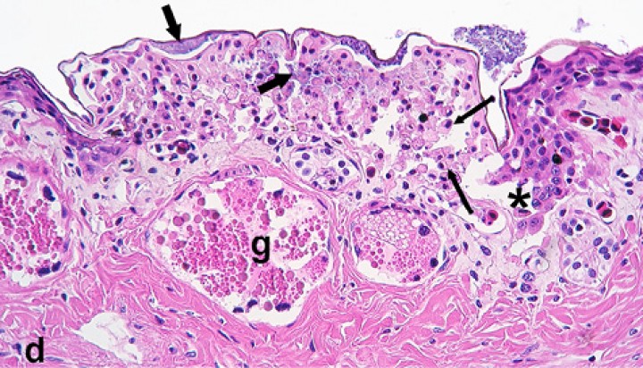 <p>Piel; tritón cocodrilo de Kweichow (<em>Tylototriton kweichowensis</em>). Imagen de una vesícula epidérmica repleta de queratinocitos acantolíticos (flechas largas) y necróticos, y colonias bacterianas (flechas cortas); *: transición con la epidermis no afectada, d: dermis, g: glándula granular. Hematoxilina-eosina, x200.</p>