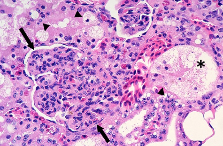 <p>Riñón; sapito balear (<em>Alytes muletensis</em>). Se observa hipercelularidad intensa con engrosamiento leve del mesangio de un glomérulo (flechas) e infiltración y marginación de células inflamatorias en capilares (glomerulonefritis mesangioproliferativa); arriba en el centro se distingue un glomérulo no afectado para comparación. Una lesión adicional consiste en vacuolización citoplasmática del epitelio tubular o degeneración vacuolar franca (cabezas de flecha) y necrosis (asterisco). Hematoxilina-eosina, x480.</p>