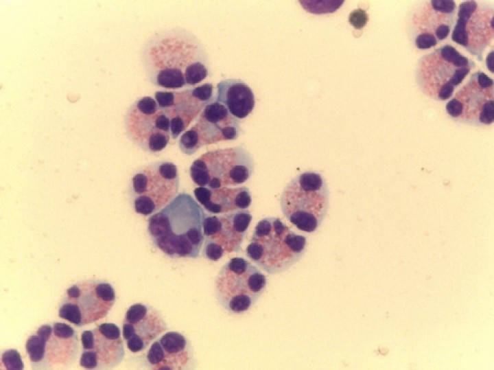 <p>Líquido cefalorraquídeo del paciente en el que se observa una pleocitosis eosinofílica marcada junto con un linfocito y un monocito aislados. Hematoxilina-eosina, 100X.</p>