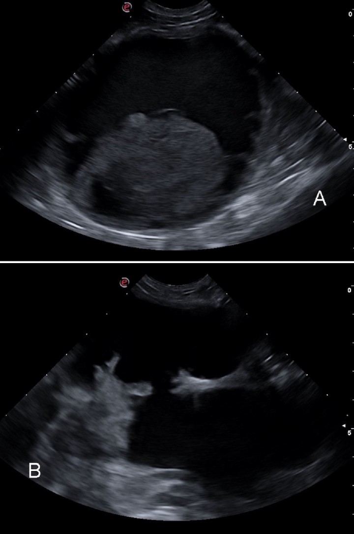 <p>Imágenes ecográficas de los quistes paraprostáticos. (<strong>A</strong>) Corte longitudinal de un quiste abdominal con contenido hipoecogénico y centro ecogénico. (<strong>B</strong>) Corte transversal de quiste paraprostático en la zona perineal, con contenido anecógeno en su interior.</p>