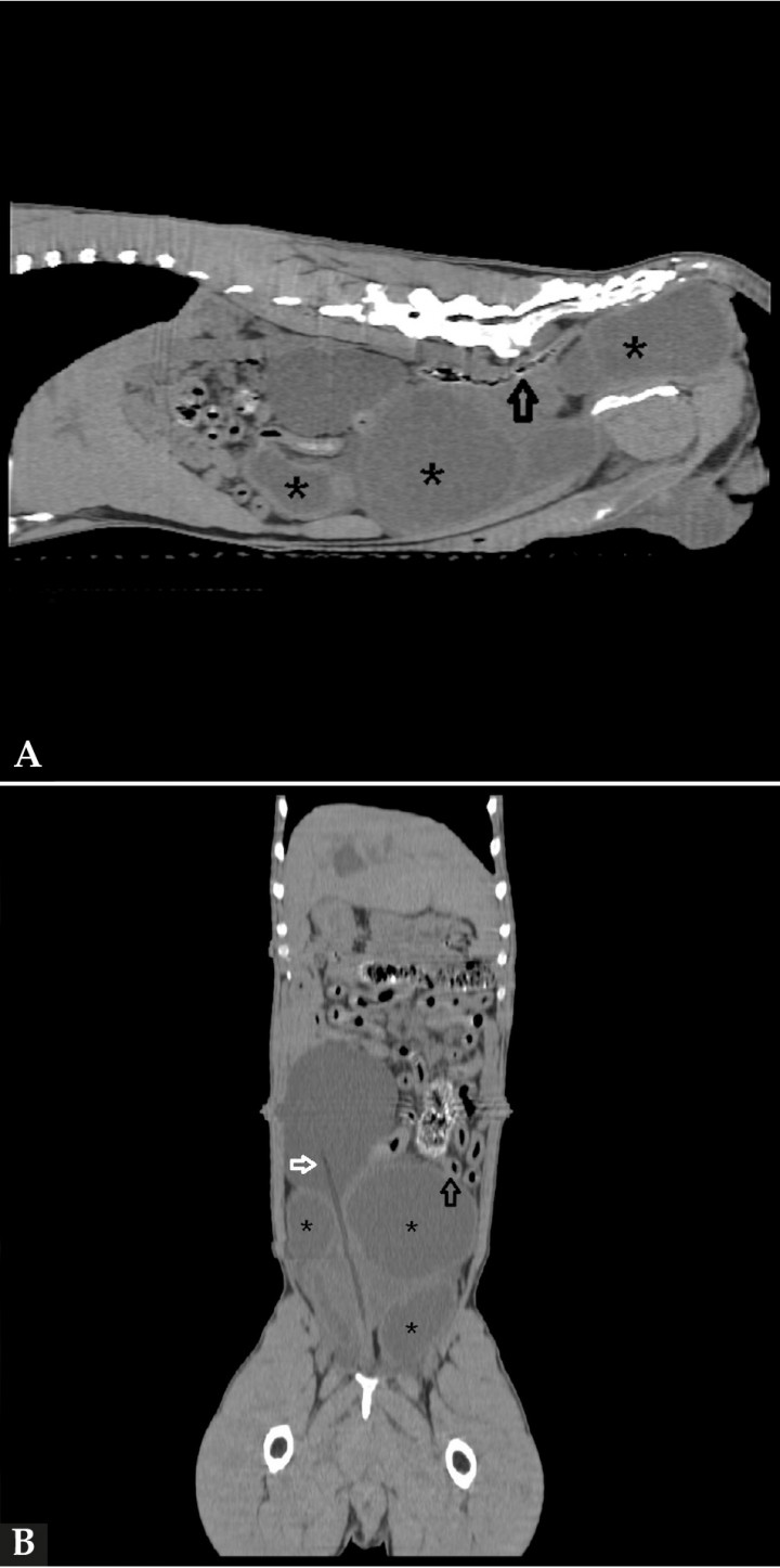 <p>Imágenes de tomografía computarizada. (<strong>A</strong>) Reconstrucción en plano sagital en ventana de tejidos blandos. Se visualizan los quistes paraprostáticos (asteriscos) y el desplazamiento del colon (flecha negra) (<strong>B</strong>) Reconstrucción en plano dorsal en ventana de tejidos blandos. Diferenciamos los quistes paraprostáticos (asteriscos) de la vejiga de la orina con presencia del catéter urinario (flecha blanca). Además se evidencia el desplazamiento de las asas intestinales (flecha negra).</p>