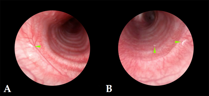 <p>Presencia de L1 de <em>Oestrus</em> sp. (puntas de flecha verdes). (<strong>A</strong>) Tráquea cervical. (<strong>B</strong>) Tráquea torácica.</p>