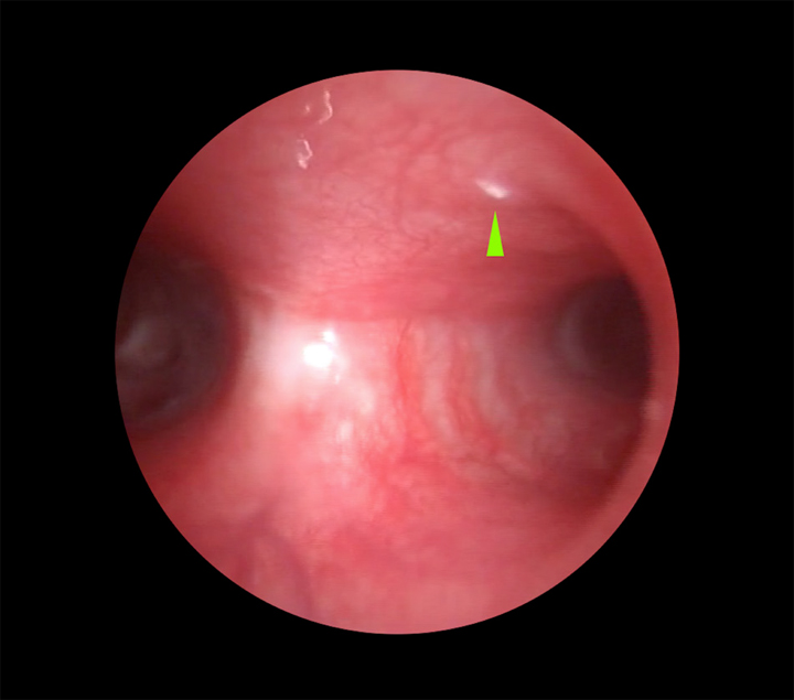 <p>Imagen endoscópica de la carina, comprobándose la existencia de L1 de <em>Oestrus</em> sp. en el bronquio principal izquierdo (punta de flecha verde).</p>
