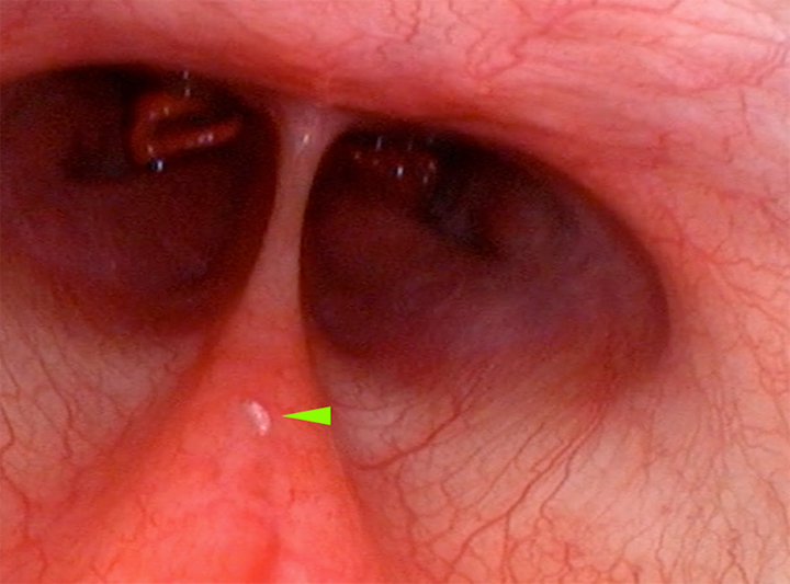 <p>Confirmación endoscópica de la existencia a nivel nasofaríngeo de L1 de <em>Oestrus</em> sp. en el mismo paciente (punta de flecha verde).</p>