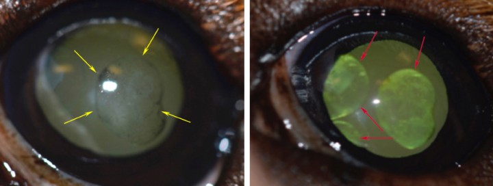 <p><strong>Quistes uveales o quistes de iris. </strong>Esferas más o menos pigmentadas presentes en el segmento anterior. La mayoría son visibles cuando ocupan la cámara anterior. Estos quistes suelen ser semitranslúcidos y esto ayuda a diferenciarlos de procesos neoplásicos uveales/iridales. En estas dos imágenes demostramos la visualización de quistes uveales. En la foto de la izquierda podemos ver nítidamente el central, que es ligeramente pigmentado y se encuentra en la cámara anterior (flechas amarillas). En la foto de la derecha, mismo ojo fotografiado pero usando retroiluminación, podemos ver el mismo quiste uveal en la cámara anterior, y otros dos saliendo detrás del iris (flechas rojas). Se pueden eliminar completamente con microcirugía o también se pueden desinflar usando el láser diodo sin necesidad de entrar dentro del globo ocular. Si bien, con esta última técnica, la pared del quiste puede quedar libre o adherida en el segmento anterior pudiendo dar lugar a problemas visuales.</p>