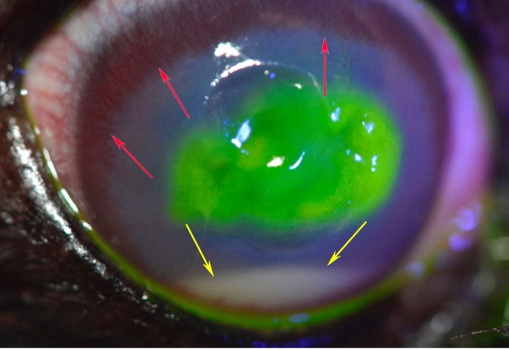 <p><strong>Úlcera complicada manejada con terapia médica intensiva. </strong>Fotografía post tinción con fluoresceína de una úlcera complicada manejada con terapia médica intensiva. Observe la reacción neovascular de la córnea periférica (flechas rojas) y la lesión rugosa central que tiñe con fluoresceína. El resto de la córnea se ve opaca debido a edema corneal, por lo que es difícil valorar las estructuras de la cámara anterior. Ventralmente podemos ver una imagen en quilla de barco, blanquecina (flechas amarillas). Este cambio llamado hipopion es un acúmulo de células blancas que han sido liberadas en la cámara anterior debido a la inflamación intraocular que ocurre en casos de ulceraciones corneales severas. Es importante que el veterinario desplace ventralmente el párpado inferior para poder valorar estos cambios.</p>