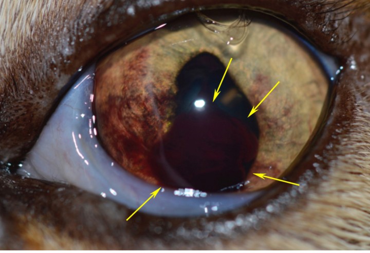 <p><strong>Sangre en la cámara anterior. </strong>Fotografía en la que se observa sangre en la cámara anterior. En el centro se puede ver un coágulo de sangre que tapa parcialmente la pupila (flechas amarillas). Si observamos el iris medial (a la izquierda) se puede observar como el tejido muestra restos de hematoma que cubren parte del iris. El tejido iridal también es anómalo con hemorragias intraestromales (hemorragias dentro del tejido iridal). De hecho, si observamos ahora la pupila, podemos ver como está discórica, es decir, ha perdido su forma clásica verticalmente elongada en gatos, posiblemente por las alteraciones vasculares observadas. Este caso muestra cambios indicativos de un proceso localizado en el globo ocular, como traumatismo romo, o bien de alteraciones sistémicas como: hipertensión, coagulopatía, infecciones por <em>Ehrlichia </em>spp. u otras. El plan debe consistir en identificar la causa de este cambio y su tratamiento debe adecuarse a la patología primaria.</p>