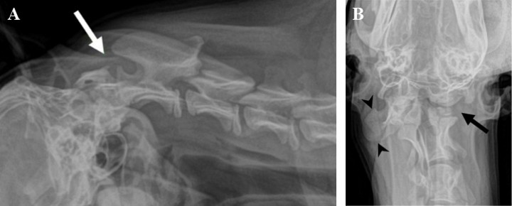 <p><strong>(A) </strong>Radiografía lateral de la columna cervical. Nótese el desplazamiento dorsal del cuerpo del axis con respecto al atlas y la distancia anormalmente amplia entre la apófisis espinosa del axis y el arco del atlas (flecha).<strong> (B) </strong>Radiografía ventrodorsal de la columna cervical craneal. Nótese la ausencia de la mitad izquierda del atlas (flecha). Compárese con el lado contrario en el que se puede evidenciar el ala del atlas formado normalmente (puntas de flecha) quedando asociado a una rotación anómala de la cabeza.</p>