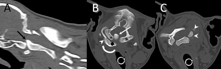 <p><strong>(A) </strong>Reconstrucción sagital obtenida mediante TC de la unión craneocervical. Obsérvese el desplazamiento craneal del axis sobre el cuerpo del atlas que hace que el diente deformado y engrosado sobrepase el hueso basioccipital desplazando a la médula oblonga (flecha), denominado invaginación basilar. <strong>(B)</strong> Imagen transversal obtenida mediante TC a nivel de los cóndilos del occipital en la que se puede apreciar como el diente del axis está incluido dentro de la cavidad craneal (flecha) y la adecuada formación de los cóndilos del occipital (asteriscos). Tambien puede apreciarse el intercentrum I (cruz) y la sincondrosis neurocentral derecha (punta de flecha), pero no la izquierda. En esta imagen la rotación del atlas es evidente teniendo en cuenta la posición del cuerpo (flecha circular que indica el sentido de la rotación). <strong>(C) </strong>Imagen transversal obtenida mediante TC a nivel de la lámina del atlas en la que se aprecian dos núcleos de osificación independientes de posición dorsolateral izquierda (puntas de flecha).</p>