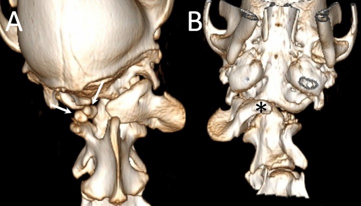 <p><strong>(A)</strong> Reconstrucción tridimensional en vista dorsal obtenida mediante TC. Obsérvese la rotación de la cabeza con respecto al eje longitudinal y la ausencia de la totalidad del arco izquierdo del atlas, donde solo es posible apreciar dos pequeños fragmentos óseos (flechas). <strong>(B) </strong>Reconstrucción tridimensional en vista ventral obtenida mediante TC en la que se aprecia el “intercentrum 1” rotado (asterisco), así como la ausencia del arco izquierdo del atlas. El defecto de la cavidad timpánica izquierda es un artefacto creado durante la reconstrucción.</p>
