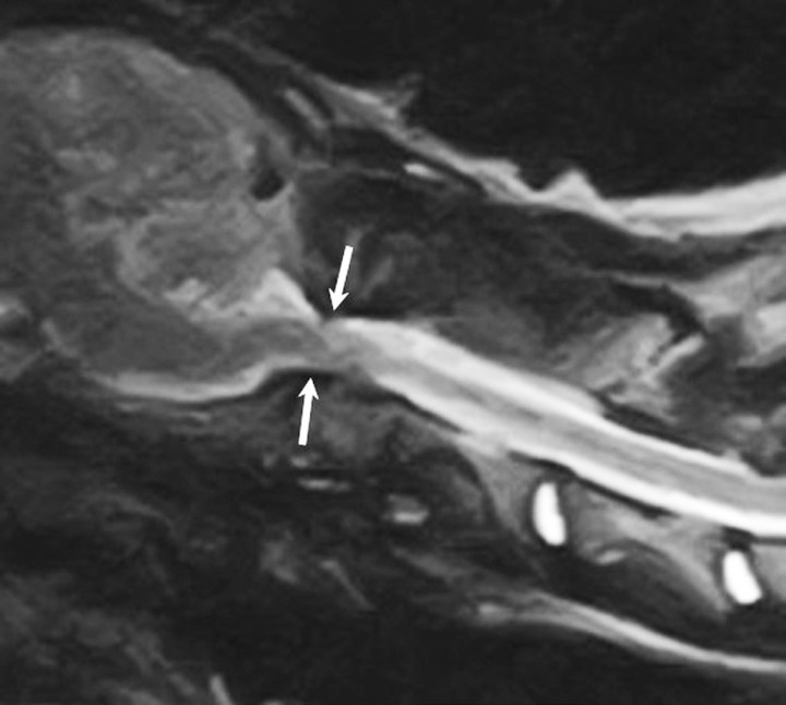 <p>Imagen sagital ponderada en T2 obtenida mediante RM de la columna cervical. Véase el compromiso medular a nivel de la articulación atlantoaxial, marcado por una obliteración del espacio subaracnoideo ventral y dorsal (flechas), lo cual produce una desviación sigmoidea del cordón medular.</p>