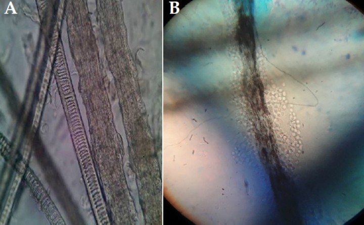 <p>Tricogramas. Se observan pelos con estructura anormal y con presencia de artrosporas. <strong>(A) </strong>Pelos en lente 10x. Se observan pelos infectados cuyo centro está invadido de esporas, pelos engrosados con estructura anormal.<strong> (B)</strong> Pelos en detalle con lente 40x; se observan las esporas refringentes en la superficie del tallo piloso.</p>